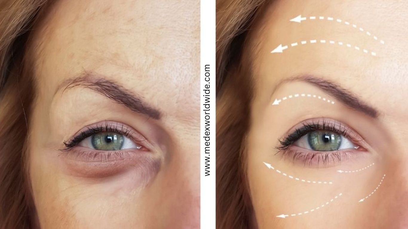 Timeless Elegance: Botox Before and After Transformations