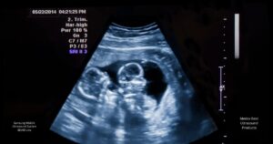 Enhancing Prenatal Experience with 3D Ultrasound